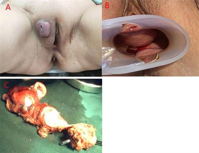 Adenosquamous Carcinoma of Skene’s Gland: A Case Report and Literature Review